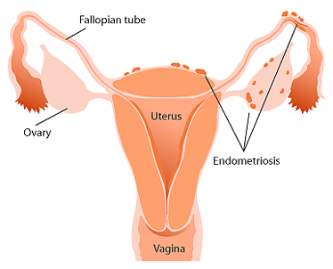 Endometriosis en ovarios