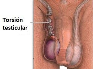 Torsión testicular