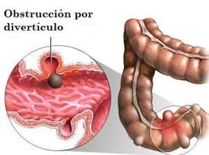 Diverticulo